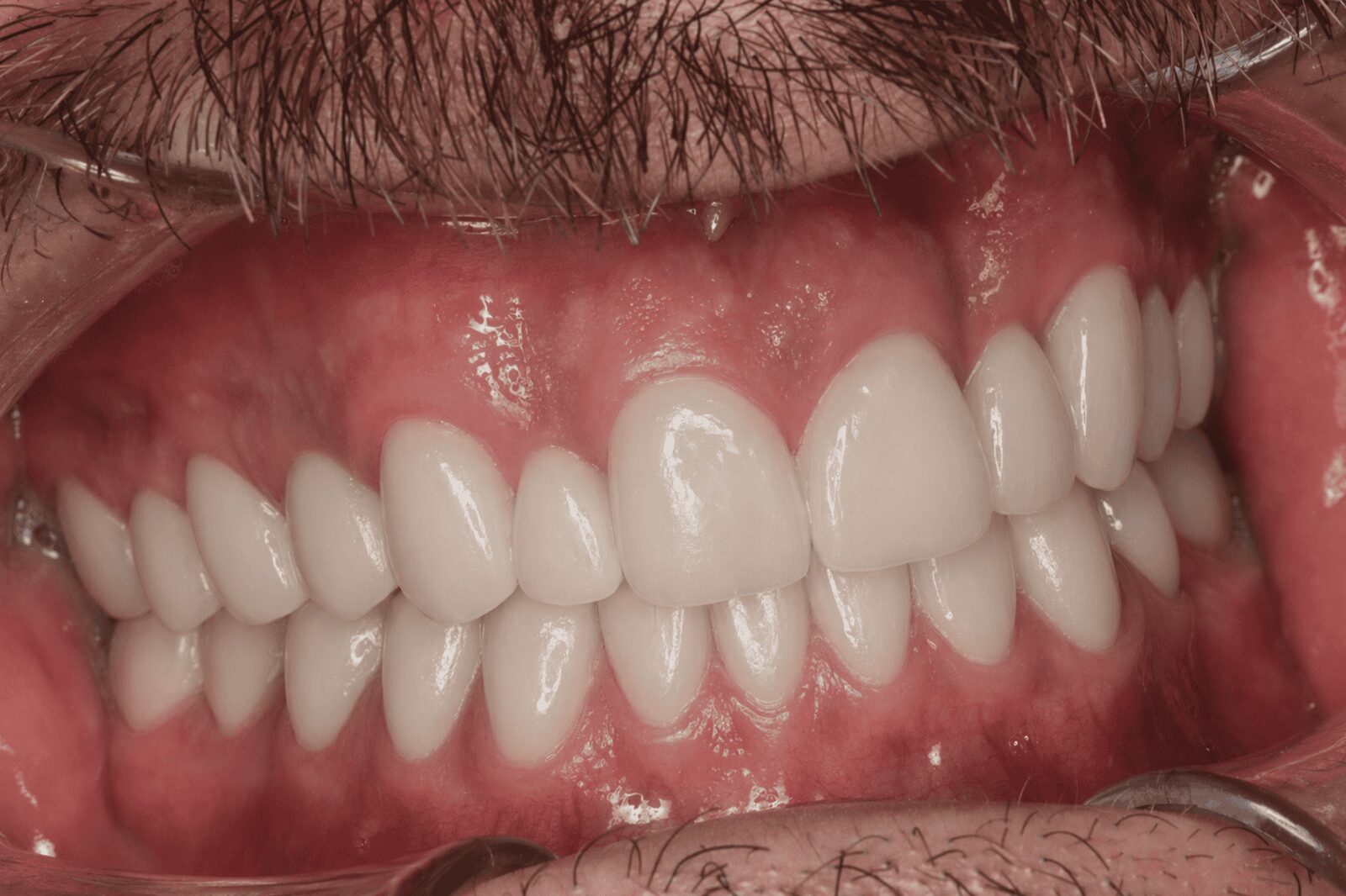 Efekt po leczeniu licówkami porcelanowymi — pacjent 1, Ivory Dental Clinic