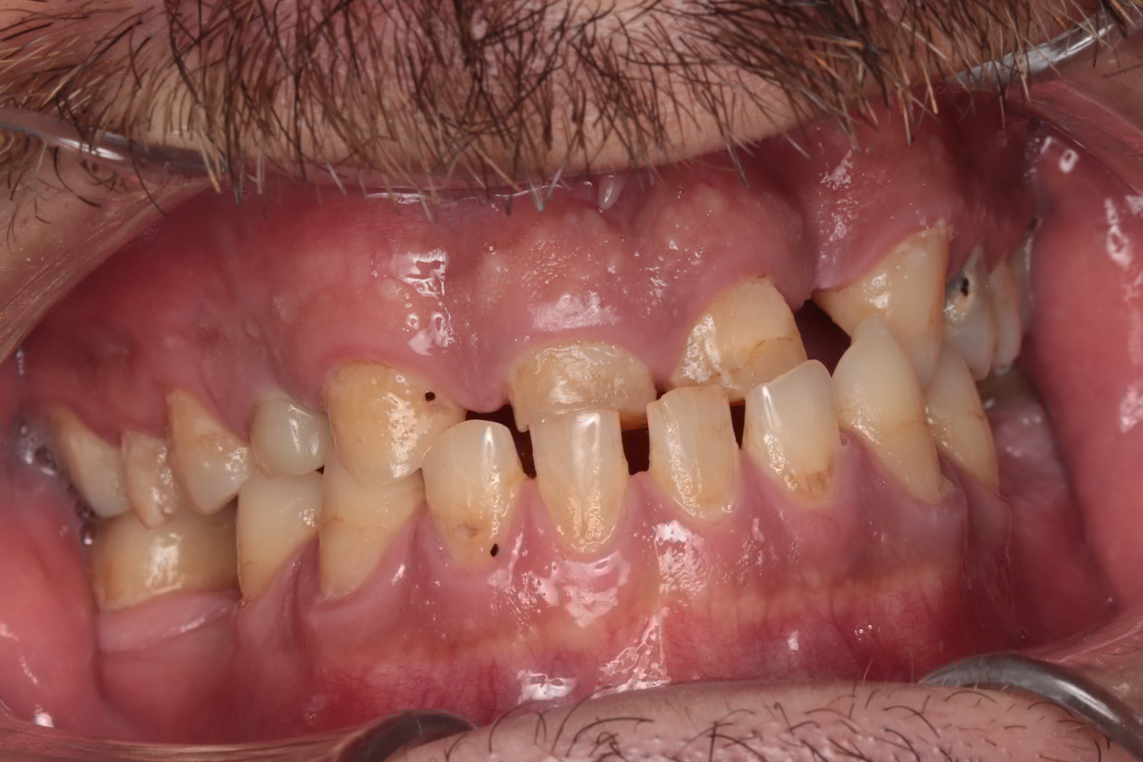 Stan przed leczeniem licówkami — pacjent 1, Ivory Dental Clinic