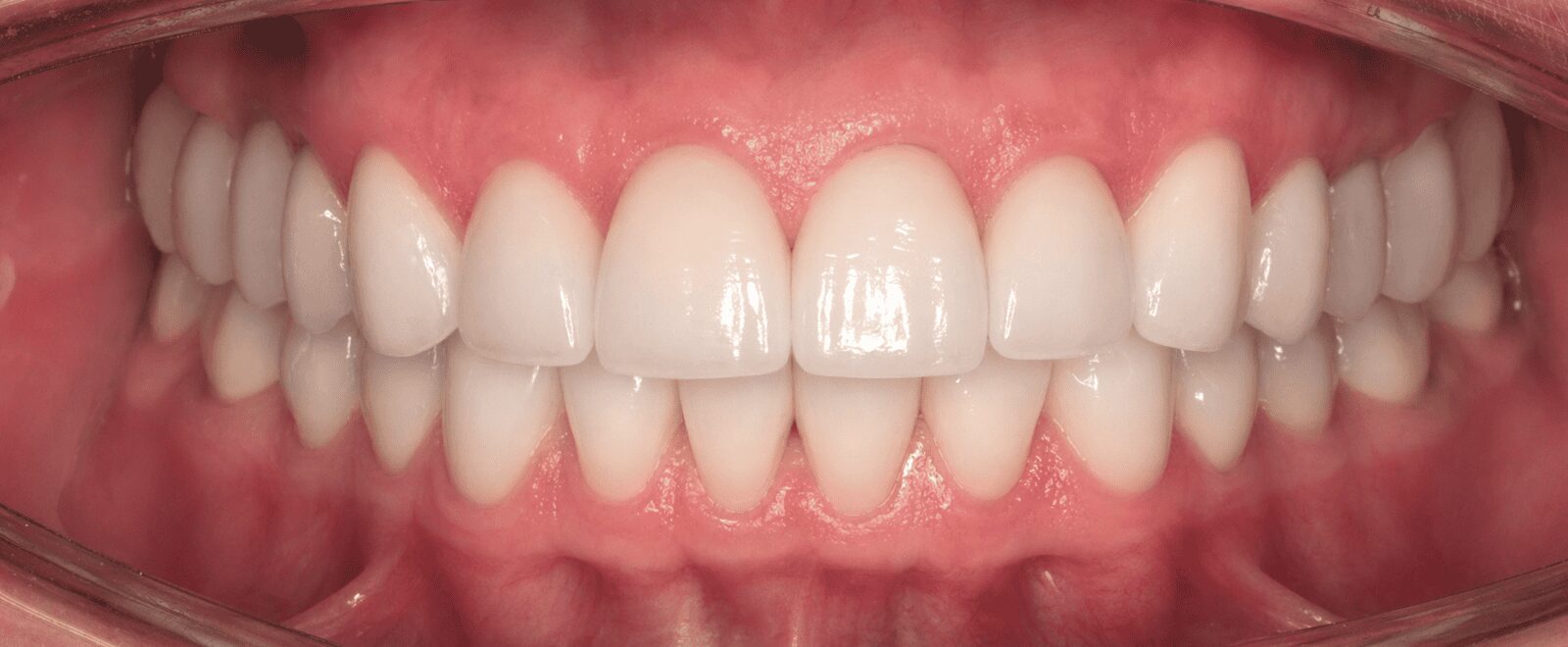 Efekt po leczeniu licówkami porcelanowymi — pacjent 4, Ivory Dental Clinic