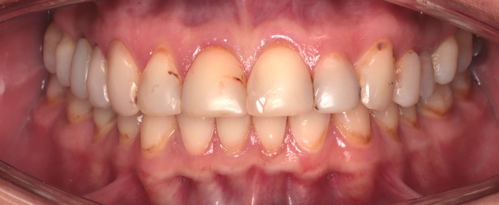 Stan przed leczeniem licówkami — pacjent 4, Ivory Dental Clinic