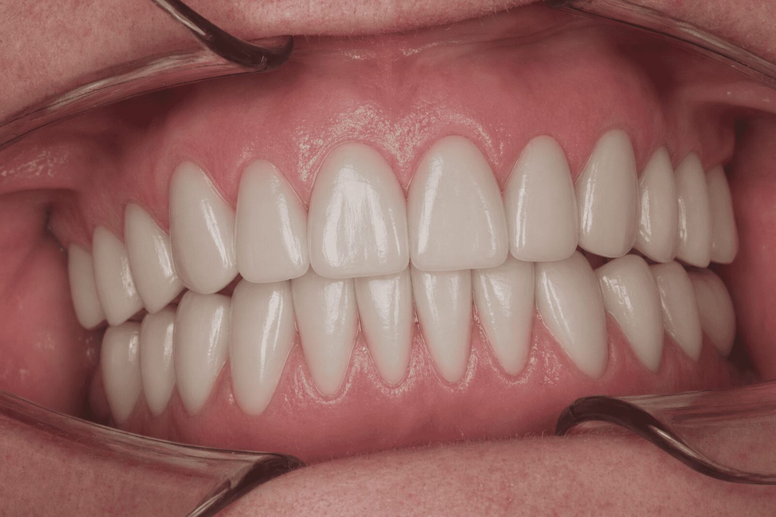 Efekt po leczeniu licówkami porcelanowymi — pacjent 2, Ivory Dental Clinic