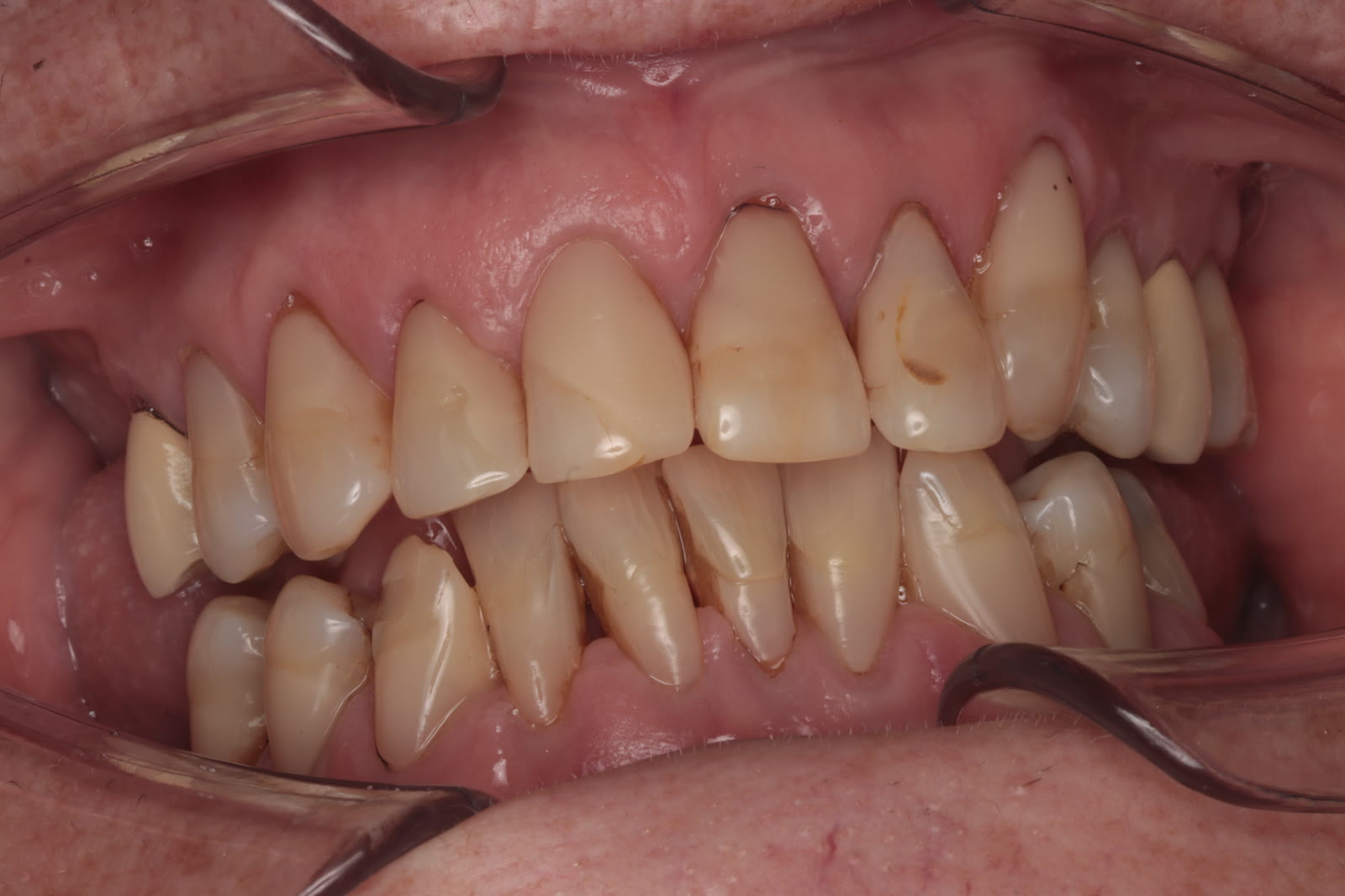 Stan przed leczeniem licówkami — pacjent 2, Ivory Dental Clinic