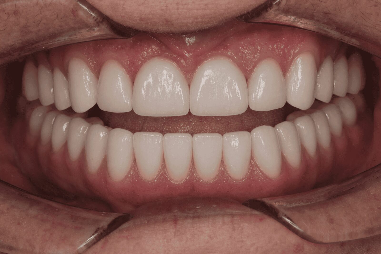 Efekt po leczeniu licówkami porcelanowymi — pacjent 3, Ivory Dental Clinic