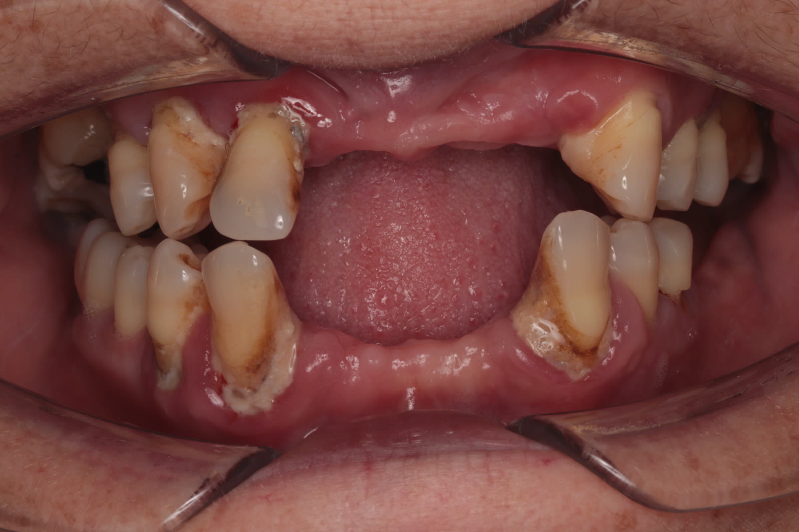 Stan przed leczeniem licówkami — pacjent 3, Ivory Dental Clinic